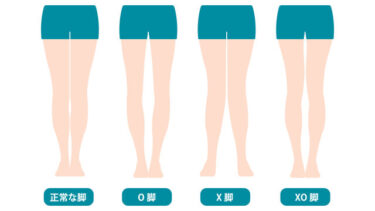 女性必見！日本人に多いO脚とは