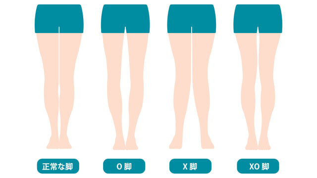 女性必見!日本人に多いO脚とは
